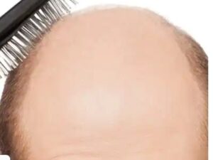 Bald Men